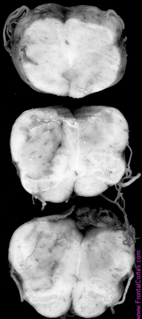 Dorsolateral medullary infarct, serial transverse sections